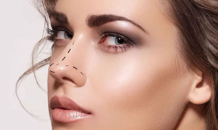 rhinoplastie paris